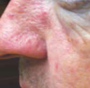 Rosacea Before Treatment